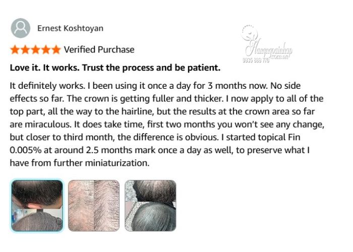 review mọc tóc Men’s Rogaine Minoxidil 5% Foam