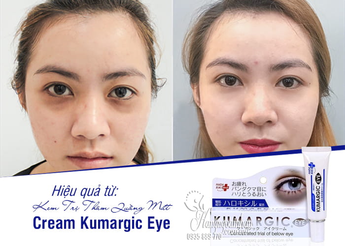 Kem Trị Thâm Quầng Mắt Cream Kumargic Eye Của Nhật 3
