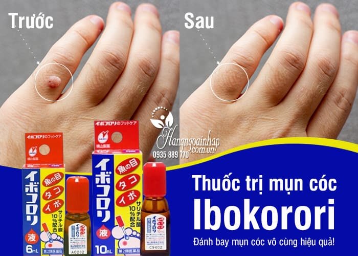 thuoc-tri-mun-coc-ibokorori-10ml-noi-dia-nhat-ban''''''''''''''''''''''''''''''''''