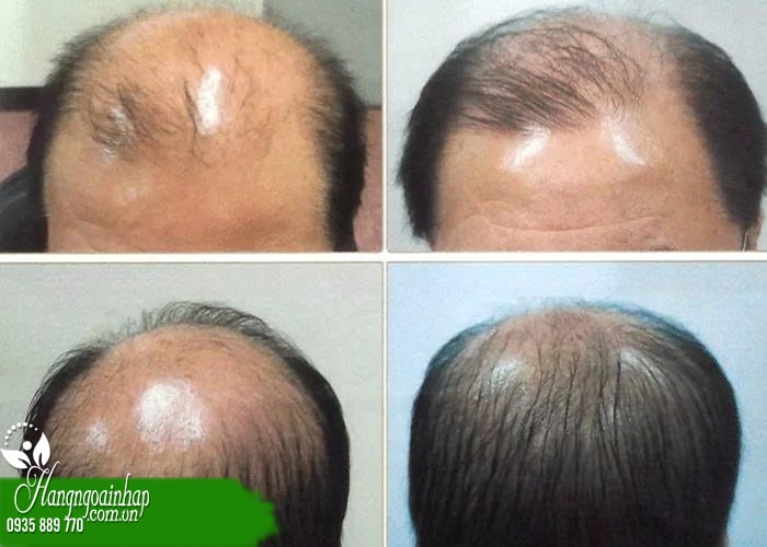 5 lưu ý khi dùng dung dịch mọc tóc tránh bị tác dụng phụ  9