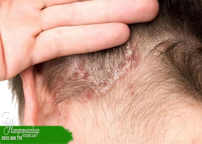 5 lưu ý khi dùng dung dịch mọc tóc tránh bị tác dụng phụ  8