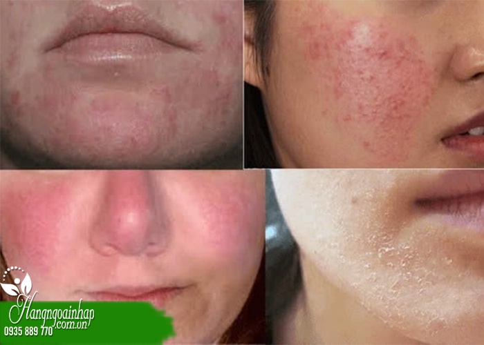 Top 5+ kem dưỡng phục hồi da Treatment nhạy cảm 1