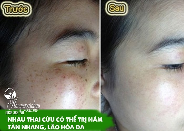 Top viên uống nhau thai cừu trị nám tàn nhang tốt nhất 6