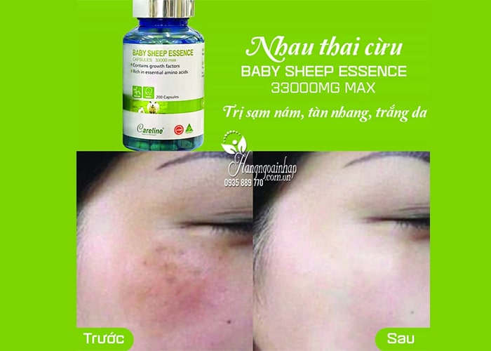Top viên uống nhau thai cừu trị nám tàn nhang tốt nhất 9