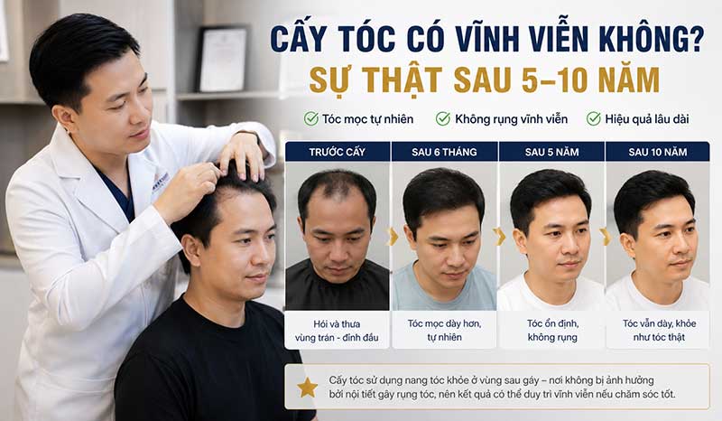 Cấy tóc có vĩnh viễn không? Đừng hiểu sai về “vĩnh viễn”
