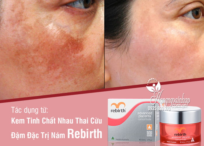 kem tinh chat nhau thai cuu dam dac tri nam rebirth 3(1)