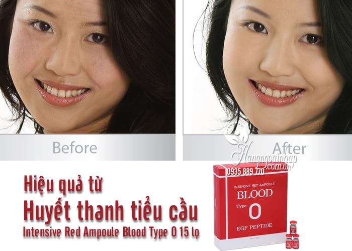 Huyết thanh tiểu cầu Intensive Red Ampoule Blood Type O 15 lọ 7