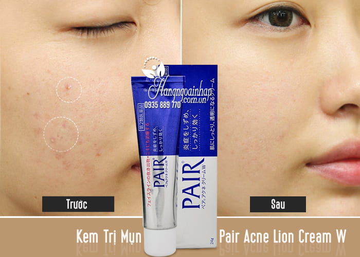 Kem Trị Mụn Pair Acne Lion Cream W 24g Của Nhật 2