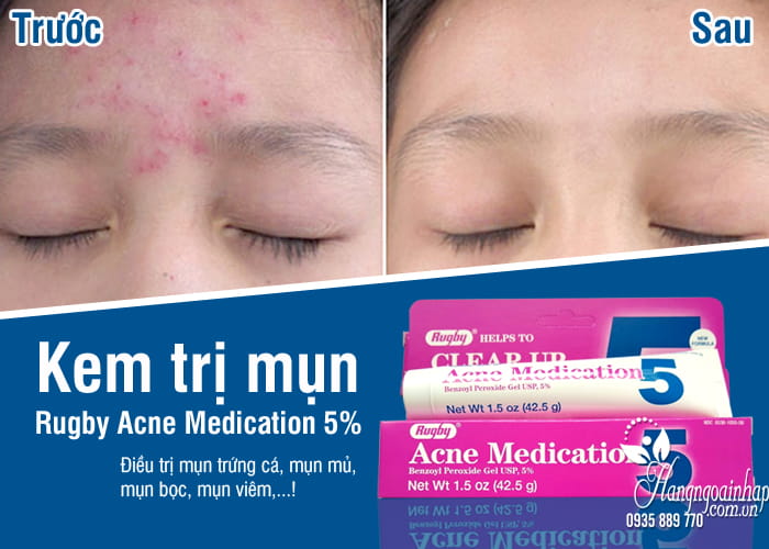 Kem trị mụn Rugby Acne Medication 5% của Mỹ 42,5g 8