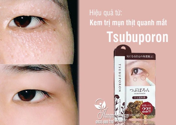 Kem trị mụn thịt quanh mắt Tsubuporon tốt nhất Nhật Bản 7