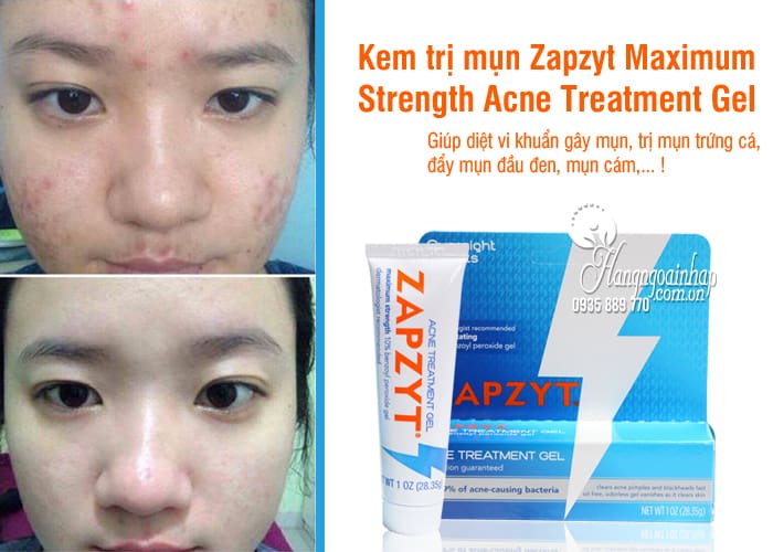 Kem trị mụn Zapzyt Maximum Strength Acne Treatment Gel của Mỹ 7