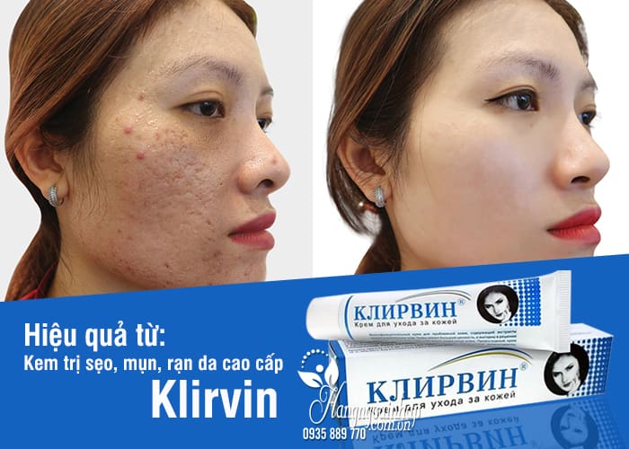 Kem trị sẹo, mụn, rạn da cao cấp Klirvin 25g của Nga 3