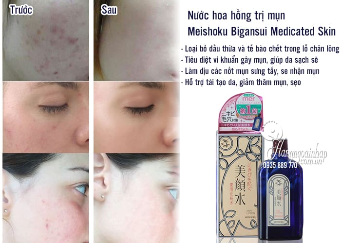 Nước hoa hồng trị mụn Meishoku Bigansui Medicated Skin 80ml 12