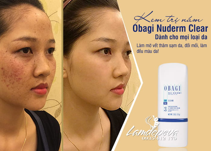 Kem trị nám Obagi Nuderm Clear số 3 dành cho mọi loại da 2