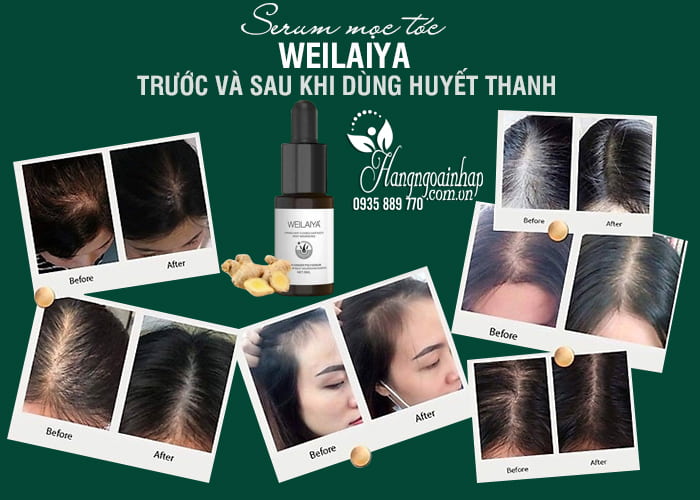 Serum kích thích mọc tóc Weilaiya chính hãng 8 chai x 5ml 2