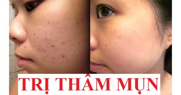 Trị thâm mụn - Không dễ nhưng không khó