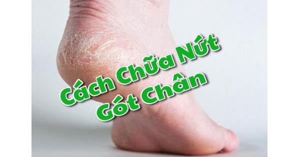 Cách chữa nứt gót chân hiệu quả nhất?