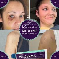 Kem làm mờ sẹo Mederma Advanced Scar Gel 20g của Mỹ