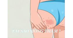 Tại sao mông bị thâm đen? Cách trị thâm mông cấp tốc tại nhà?