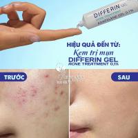 Kem trị mụn Differin Gel Acne Treatment 0,1% tuýp 15g