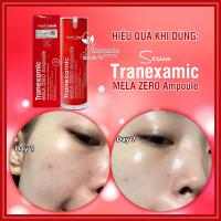 Serum Tranexamic Mela Zero Ampoule Angels Liquid 30ml Hàn Quốc