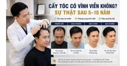 Cấy tóc có vĩnh viễn không? Sự thật sau 5–10 năm