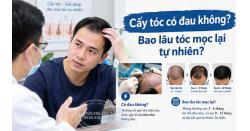 Cấy tóc có đau không? Bao lâu tóc mọc lại tự nhiên?