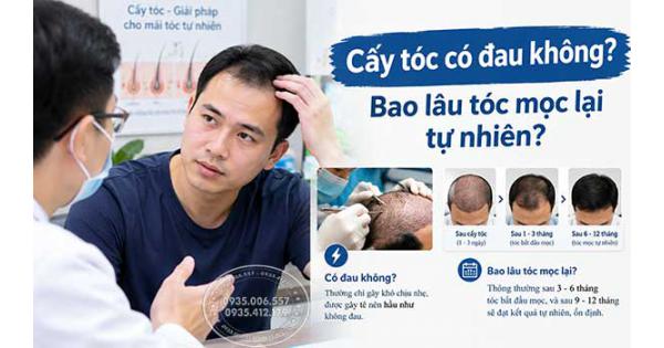 Cấy tóc có đau không? Bao lâu tóc mọc lại tự nhiên?