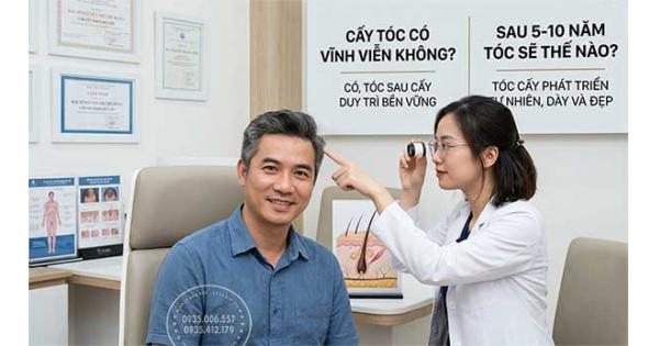 Cấy tóc có vĩnh viễn không? Sau 5–10 năm tóc sẽ thế nào?