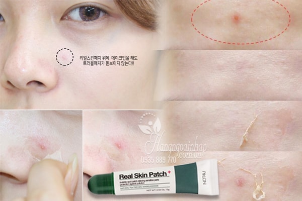 Gel che mụn thần thánh Not4U Real Skin Patch 15g của Hàn Quốc