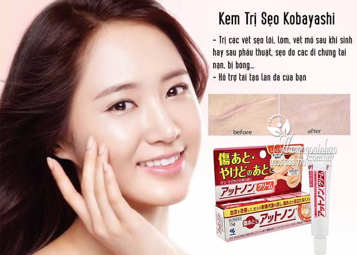 Kem Trị Sẹo Kobayashi Của Nhật Bản 2