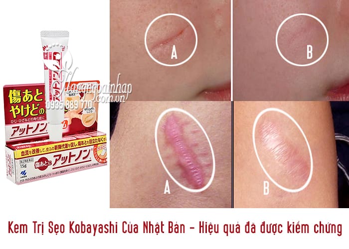 Kem Trị Sẹo Kobayashi Của Nhật Bản 3