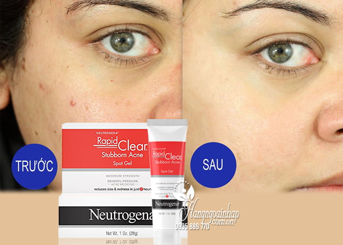 Gel trị mụn Neutrogena Rapid Clear Stubborn Acne Spot Gel 28g 2