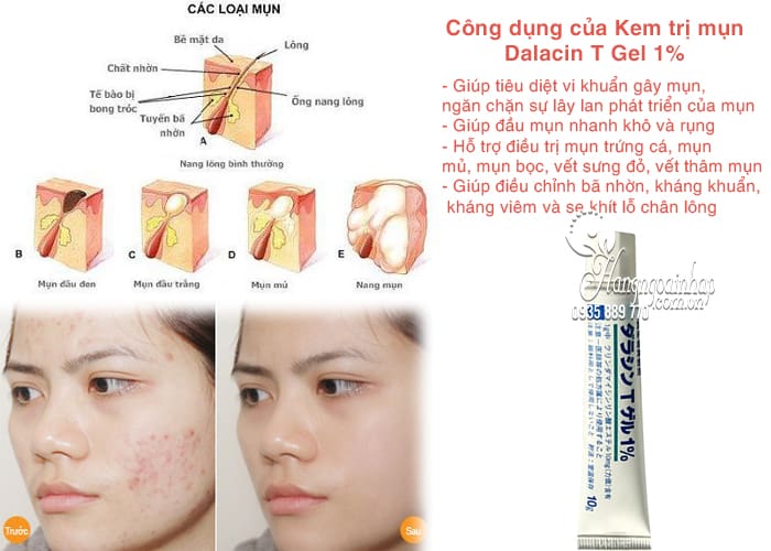 Kem trị mụn Dalacin T Gel 1% của Nhật Bản hiệu quả nhất 3