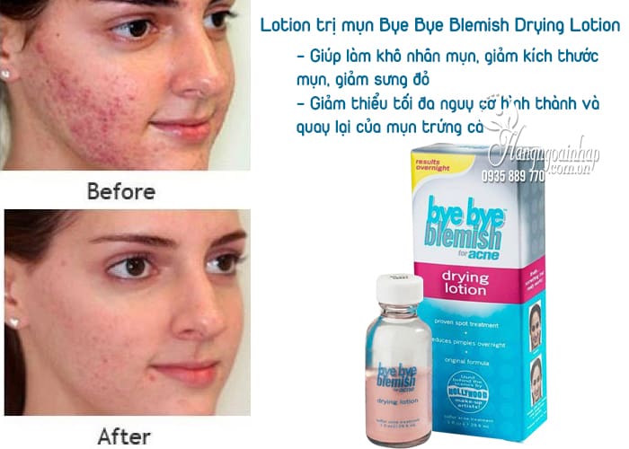 Lotion trị mụn Bye Bye Blemish Drying Lotion của Mỹ 2