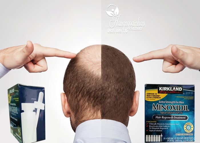 Thuốc Mọc Tóc Kirkland Minoxidil Tốt Không Giá Bao Nhiêu