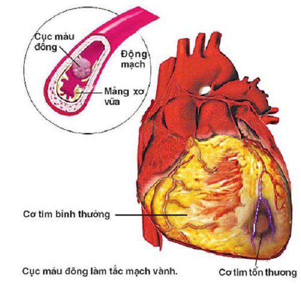 Nattokinase có tác dụng gì