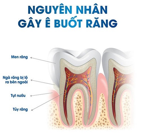 nguyên nhân gây ê buốt răng