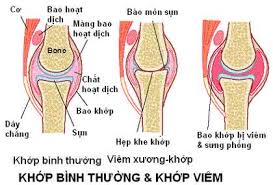 benh viem khop