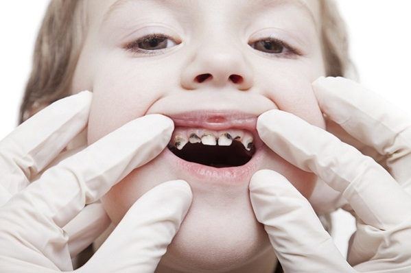 một số bệnh răng miệng thường gặp
